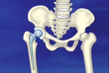 Νέα τεχνική αρθροπλαστικής ισχίου μειώνει στις 24 ώρες το χρόνο νοσηλείας