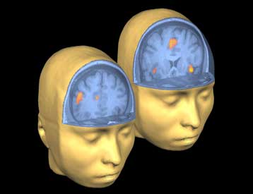 Σπάνιο γονίδιο προδιαθέτει για αδύναμη μνήμη