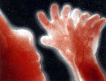 Αμερικανίδα ανακαλύπτει ότι ως έμβρυο είχε συγχωνευτεί με τη δίδυμη αδερφή της