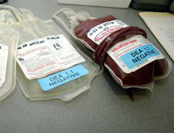 Πιθανή περίπτωση μετάδοσης σπογγώδους εγκεφαλοπάθειας από μετάγγιση στη Βρετανία