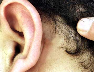 Ηλεκτρόδια που εισάγονται μέσα στον εγκέφαλο καταπολεμούν την κώφωση