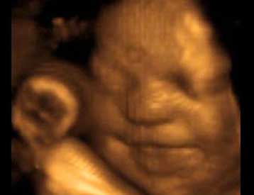 Εικονική μήτρα προβλέπει τις πρόωρες γεννήσεις