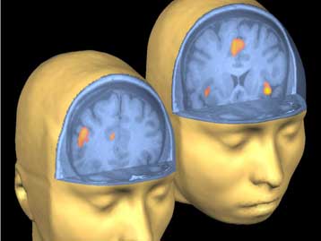 Τα εγκεφαλικά ημισφαίρια συνεργάζονται καλύτερα στις μαθηματικές ιδιοφυίες