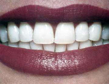 Μέθοδος αναγέννησης των δοντιών αναπτύσσεται στη Βρετανία