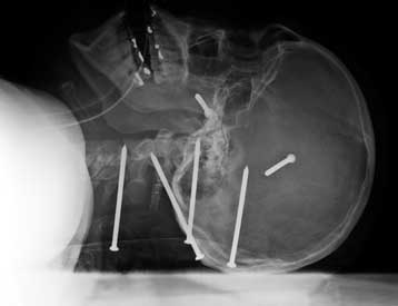 Εργάτης επιζεί με έξι καρφιά σφηνωμένα στο κρανίο του