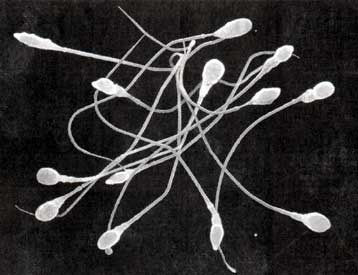 Μωρό γεννιέται από σπέρμα κατεψυγμένο για 21 χρόνια