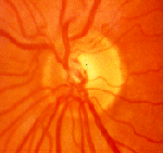 Οι στατίνες μειώνουν τον κίνδυνο γλαυκώματος