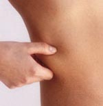 Η λιποαναρρόφηση δεν μειώνει τον κίνδυνο καρδιαγγειακού νοσήματος