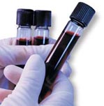 Αίμα από ομφάλιο λώρο και πλακούντα για τη θεραπεία ασθενειών