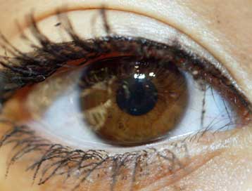 Εμφύτευμα μικροτσίπ στον αμφιβληστροειδή αποκαθιστά μερικώς την όραση