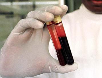 Τράπεζα βλαστικών κυττάρων από ομφάλιους λώρους λειτουργεί και στην Ελλάδα