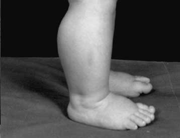 Γονίδιο που διογκώνει θεαματικά τους μύες ανακαλύφθηκε σε σωματώδες νήπιο