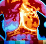 Νέα πειραματική θεραπεία του πρώιμου καρκίνου του μαστού