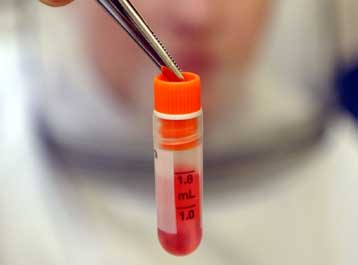 Κύτταρα μυελού των οστών αποκαθιστούν βλάβες από καρδιακές προσβολές