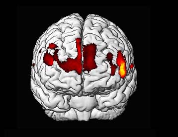 Η νοημοσύνη σχετίζεται με τον όγκο και την κατανομή της φαιάς ουσίας
