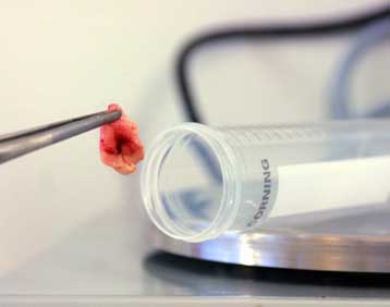 Συνθετική πρωτεΐνη προκαλεί συμπτώματα τρελών αγελάδων