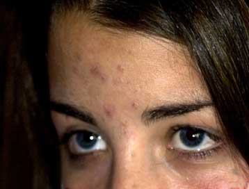 Ένζυμα που αποδομούν το δέρμα παράγει το βακτήριο της ακμής