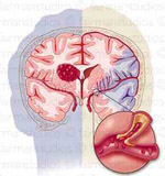 Εγκεφαλικό επεισόδιο: …Ποτέ την Κυριακή