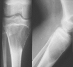 Μειωμένη οστική πυκνότητα έχουν οι πάσχοντες από κυστική ίνωση