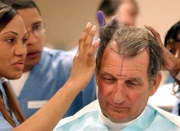 Και θεραπεία της φαλάκρας υπόσχονται τώρα τα βλαστικά κύτταρα