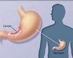 Καθυστερημένη διάγνωση του καρκίνου του στομάχου στην Ελλάδα