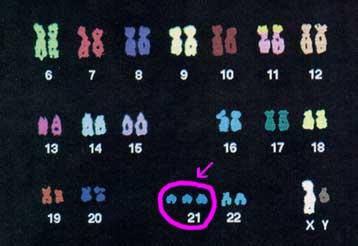 Έρευνα σε ποντίκια ανατρέπει τη θεωρία για το σύνδρομο Ντάουν