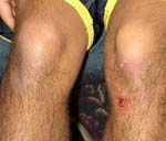 Η αύξηση του σωματικού βάρους επιβαρύνει τα γόνατα