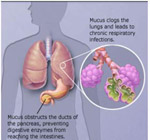 Τροποποιημένα αρχέγονα κύτταρα δίνουν ελπίδες θεραπείας της κυστικής ίνωσης