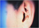 Ελπίδες θεραπείας της πρεσβυακουσίας