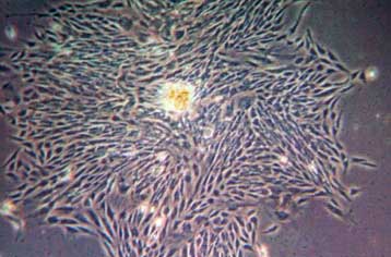 Βλαστικά κύτταρα επανορθώνουν τις βλάβες από τη νόσο του Πάρκινσον