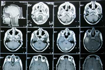 Νέο τύπο διαβήτη υποστηρίζουν ότι ανακάλυψαν Αμερικανοί ερευνητές