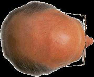 Βλαστικά κύτταρα από τα μαλλιά, και όχι μόνο για τη φαλάκρα