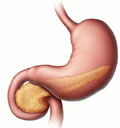 Καρκίνος Στομάχου (β’ μέρος)