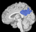Νέα μέθοδος πρώιμης διάγνωσης της νόσου Αλτσχάιμερ