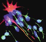 Αρχέγονα εγκεφαλικά κύτταρα στη θεραπεία του διαβήτη