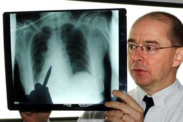 Διπλασιάστηκε σε τρεις δεκαετίες η συχνότητα ορισμένων καρκίνων