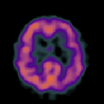 Γονιδιακή θεραπεία επιβραδύνει τη νόσο Αλτσχάιμερ