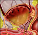 Οκτακόσιες χιλιάδες Έλληνες πάσχουν από ακράτεια ούρων