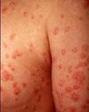 Η ψωρίαση βελτιώνεται κατά τη διάρκεια της κύησης