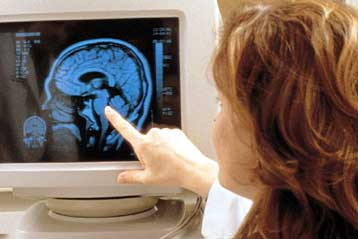 Γονιδιακή θεραπεία επιβραδύνει τη νόσο του Αλτσχάιμερ