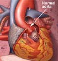 Παθήσεις της αορτής (α’ μέρος)