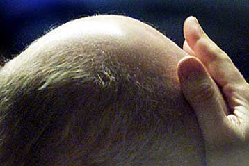 Γονίδιο που προκαλεί φαλάκρα κληρονομείται από τη μητέρα