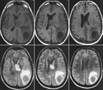 Γονιδιακός πολυμορφισμός του άσθματος μειώνει τον κίνδυνο εγκεφαλικού καρκίνου