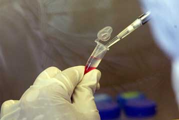 Φθηνό φάρμακο δημιουργεί ελπίδες για θεραπεία της μόλυνσης με HIV