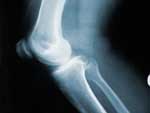 Τεχνητός χόνδρος δημιουργεί ελπίδες θεραπείας της οστεοαρθρίτιδας