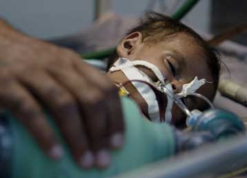 Τρίδυμα στο Πακιστάν μεγάλωναν το ένα μέσα στο άλλο