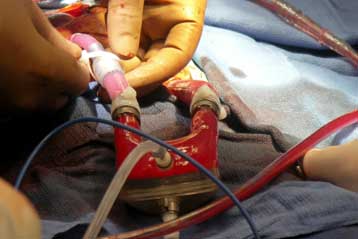 Επεμβάσεις «κλειστής καρδιάς» υπόσχονται ταχύτατη ανάρρωση