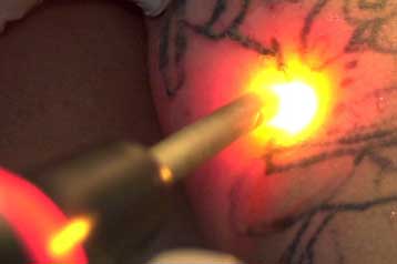 Λέιζερ που λιώνει το λίπος θα καταπολεμά κυτταρίτιδα και ακμή