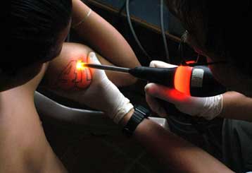 Τατουάζ με μελάνια που σβήνουν, για όσους αλλάζουν γνώμη εύκολα