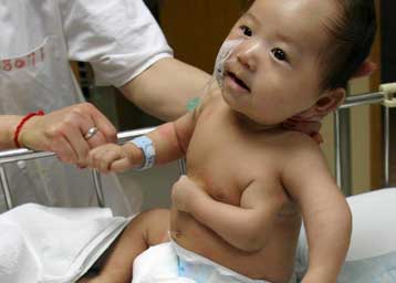 Βρέφος στην Κίνα υποβλήθηκε σε χειρουργική αφαίρεση τρίτου χεριού